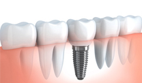 Implantes dentales Las Palmas