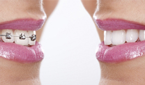 Implantes dentales en Las Palmas